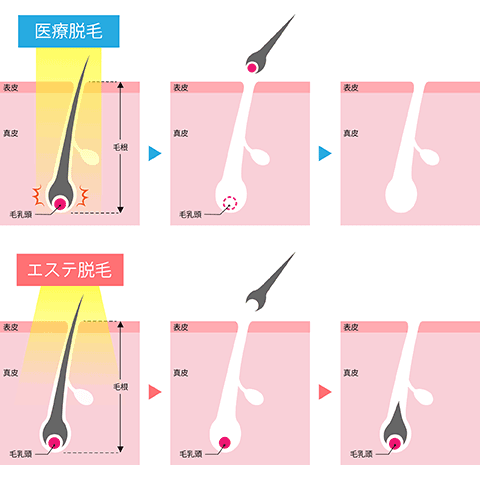 医療脱毛とサロン脱毛の違い