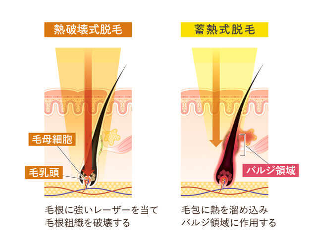 熱破壊式脱毛と蓄熱式脱毛の違い